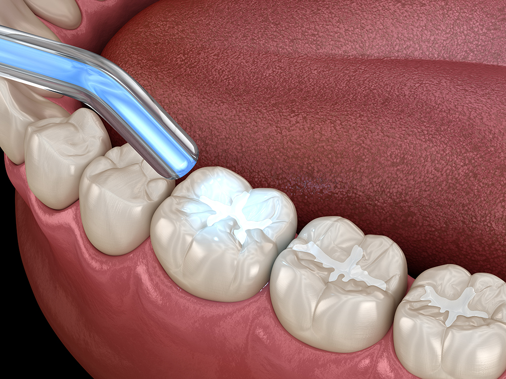 Dental Fillings