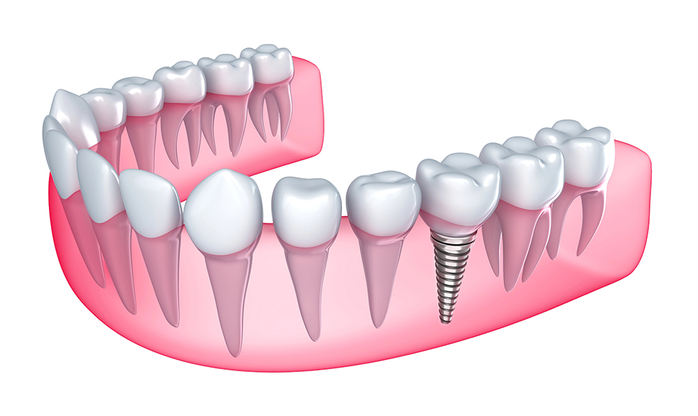 dental-implants