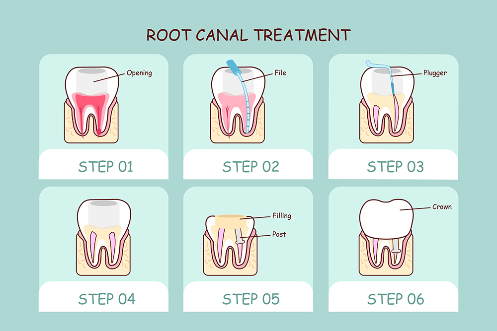 root canal